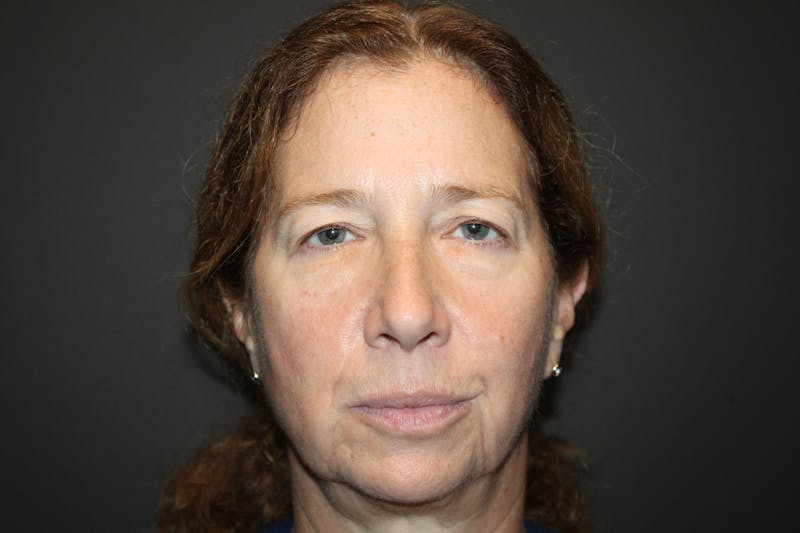 Eye Surgery Before & After Gallery - Patient 406785 - Image 1