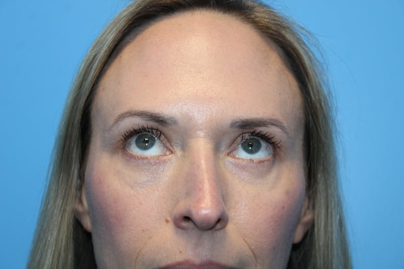 Eye Surgery Before & After Gallery - Patient 142150 - Image 4