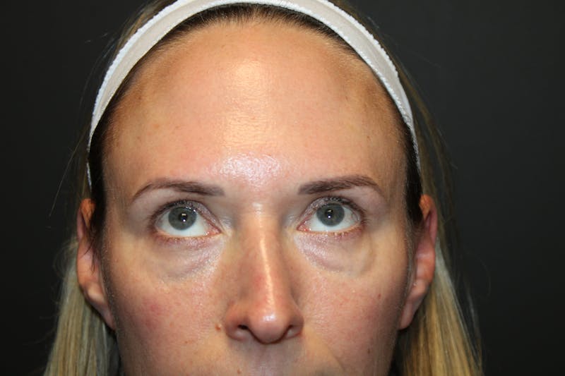 Eye Surgery Before & After Gallery - Patient 142150 - Image 3