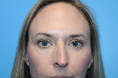 Eye Surgery Before & After Gallery - Patient 142150 - Image 2