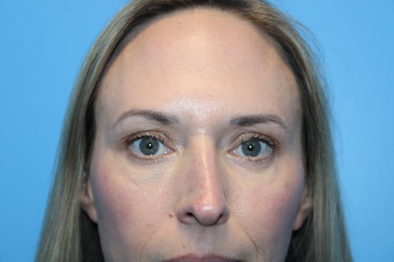 Eye Surgery Before & After Gallery - Patient 142150 - Image 2