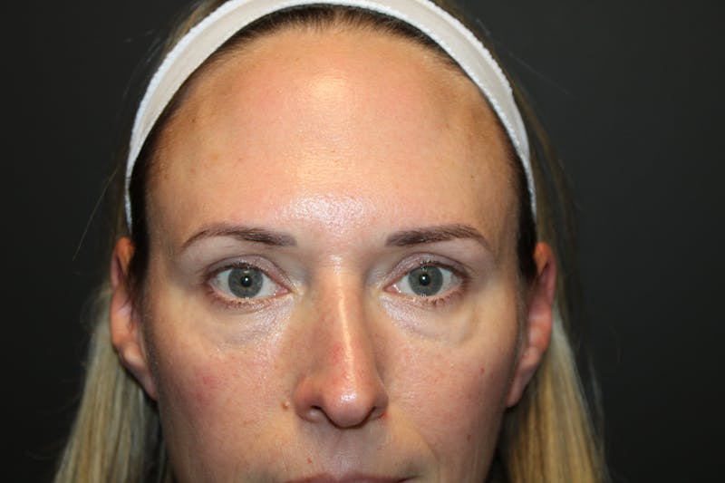 Eye Surgery Before & After Gallery - Patient 142150 - Image 1