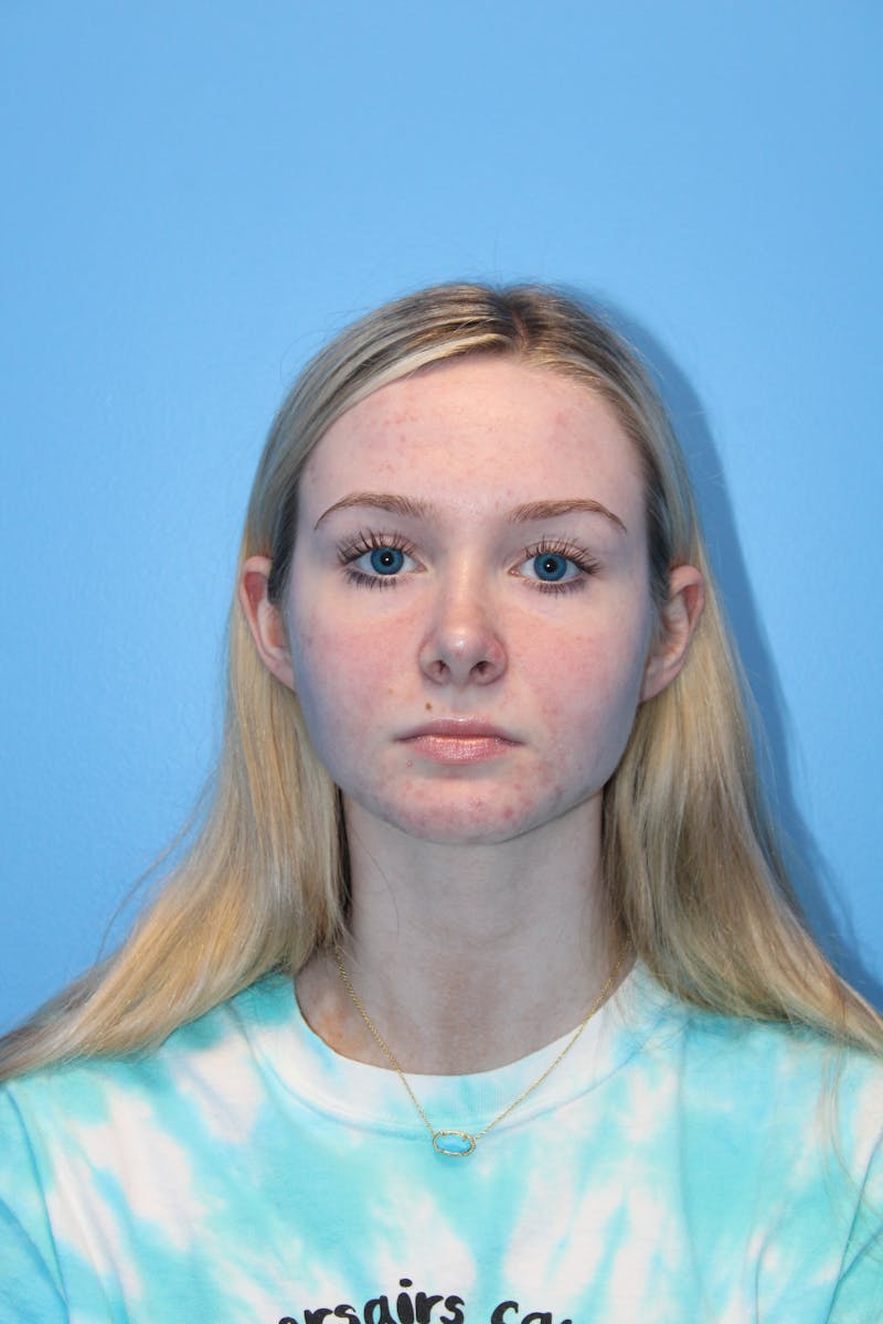 Rhinoplasty Before & After Gallery - Patient 568109 - Image 4