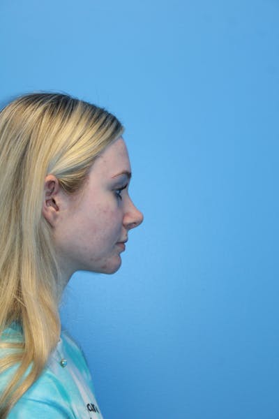 Rhinoplasty Before & After Gallery - Patient 568109 - Image 2
