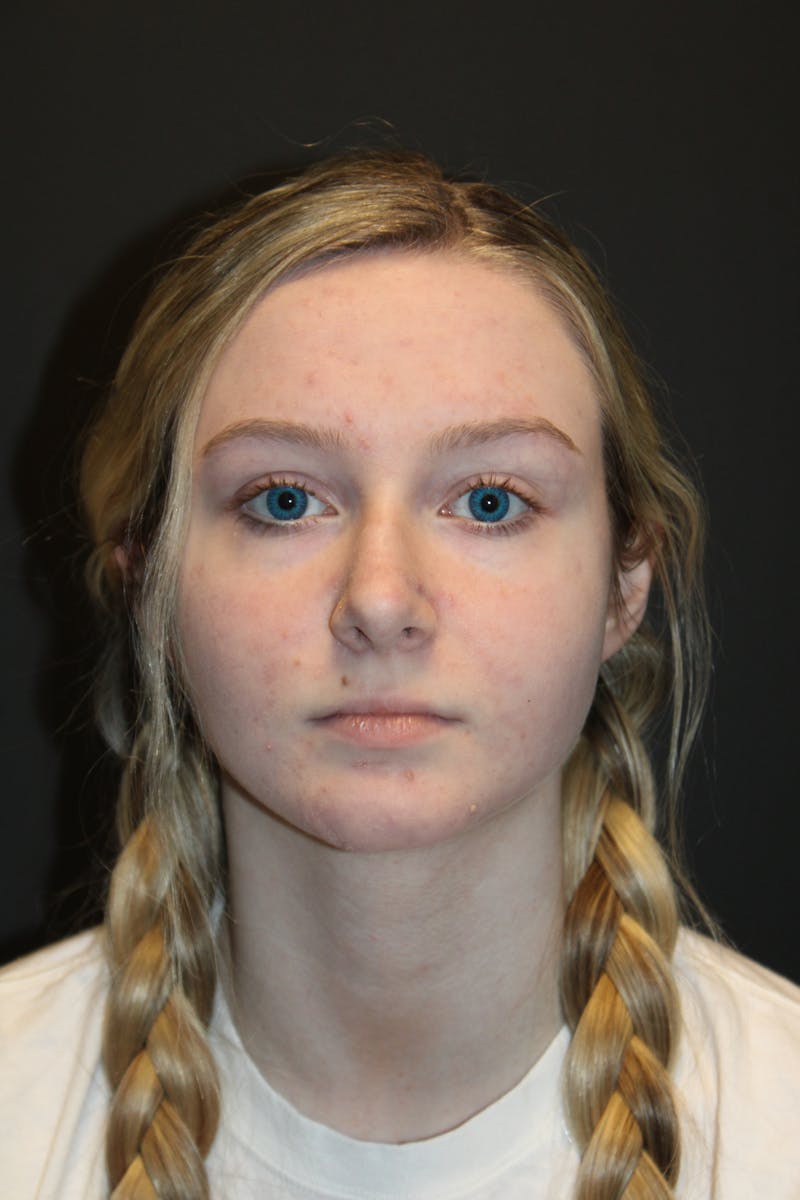 Rhinoplasty Before & After Gallery - Patient 568109 - Image 3