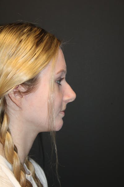 Rhinoplasty Before & After Gallery - Patient 568109 - Image 1