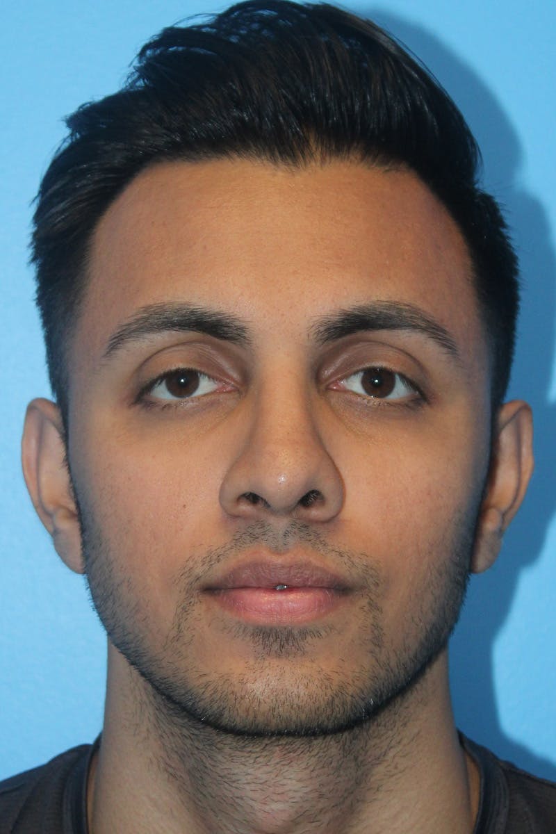 Rhinoplasty Before & After Gallery - Patient 638137 - Image 4