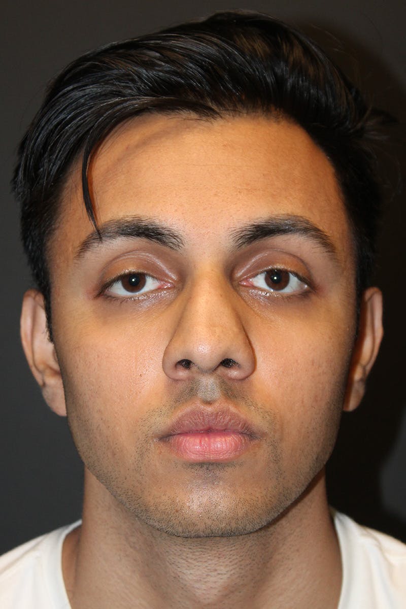 Rhinoplasty Before & After Gallery - Patient 638137 - Image 3