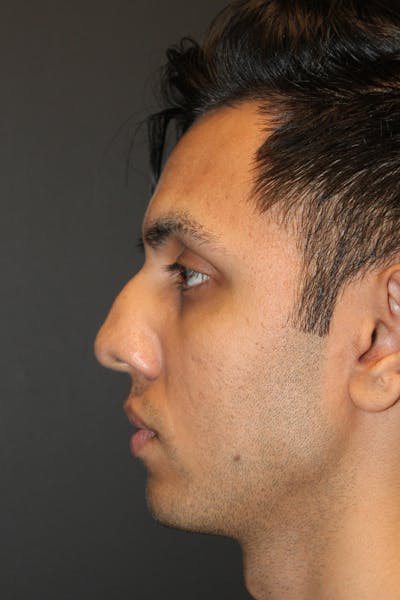 Rhinoplasty Before & After Gallery - Patient 638137 - Image 1
