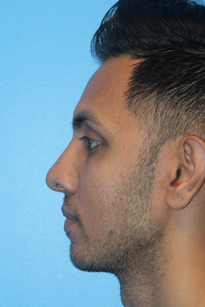 Rhinoplasty Before & After Gallery - Patient 638137 - Image 2