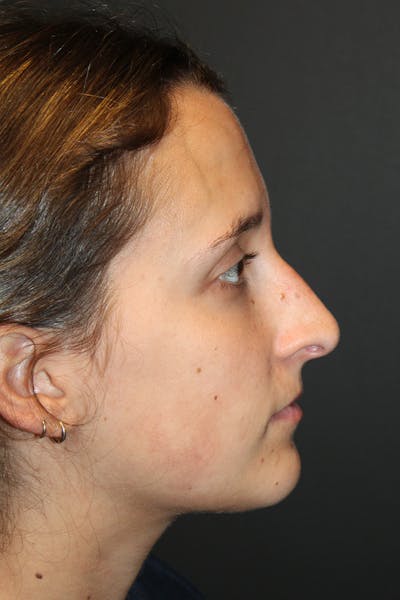Rhinoplasty Before & After Gallery - Patient 834396 - Image 1