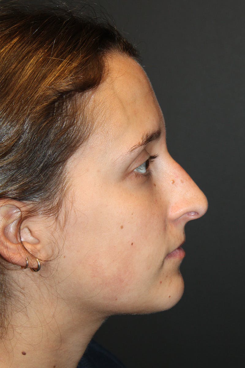 Rhinoplasty Before & After Gallery - Patient 834396 - Image 1
