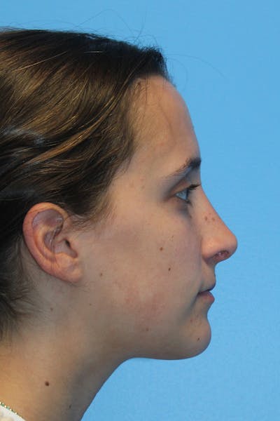 Rhinoplasty Before & After Gallery - Patient 834396 - Image 2