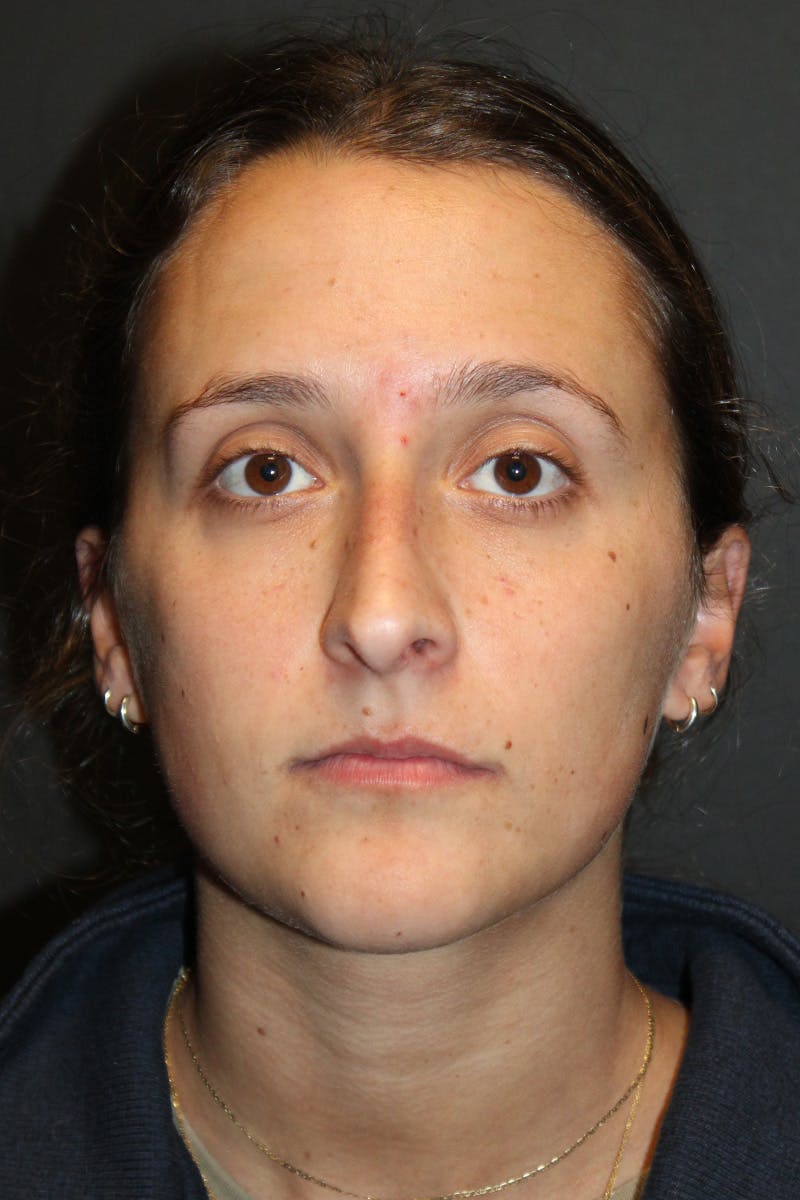 Rhinoplasty Before & After Gallery - Patient 834396 - Image 3