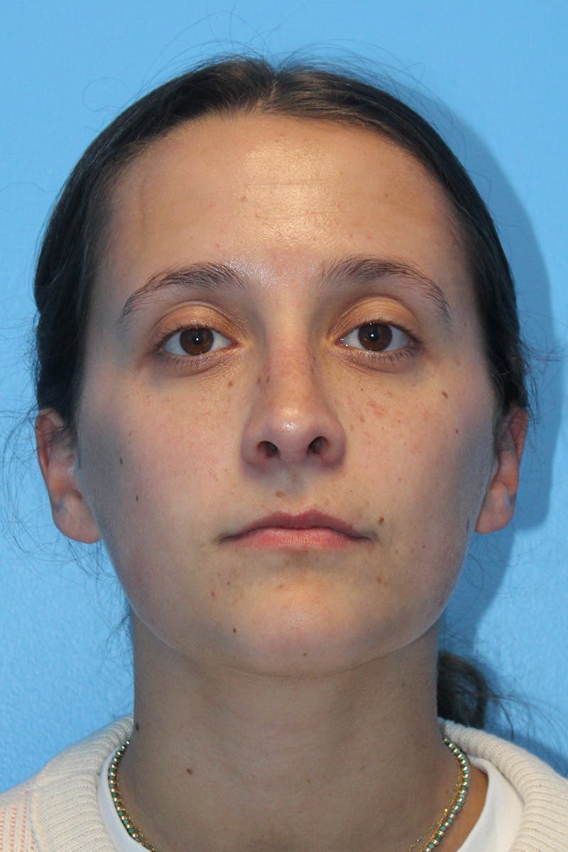 Rhinoplasty Before & After Gallery - Patient 834396 - Image 4