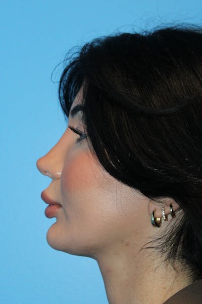 Revision Rhinoplasty Before & After Gallery - Patient 205479 - Image 2