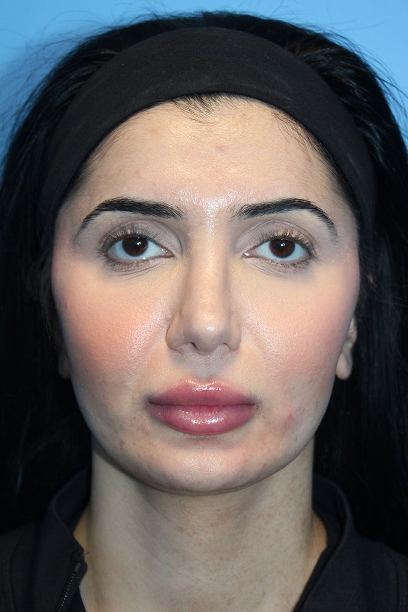Revision Rhinoplasty Before & After Gallery - Patient 205479 - Image 3