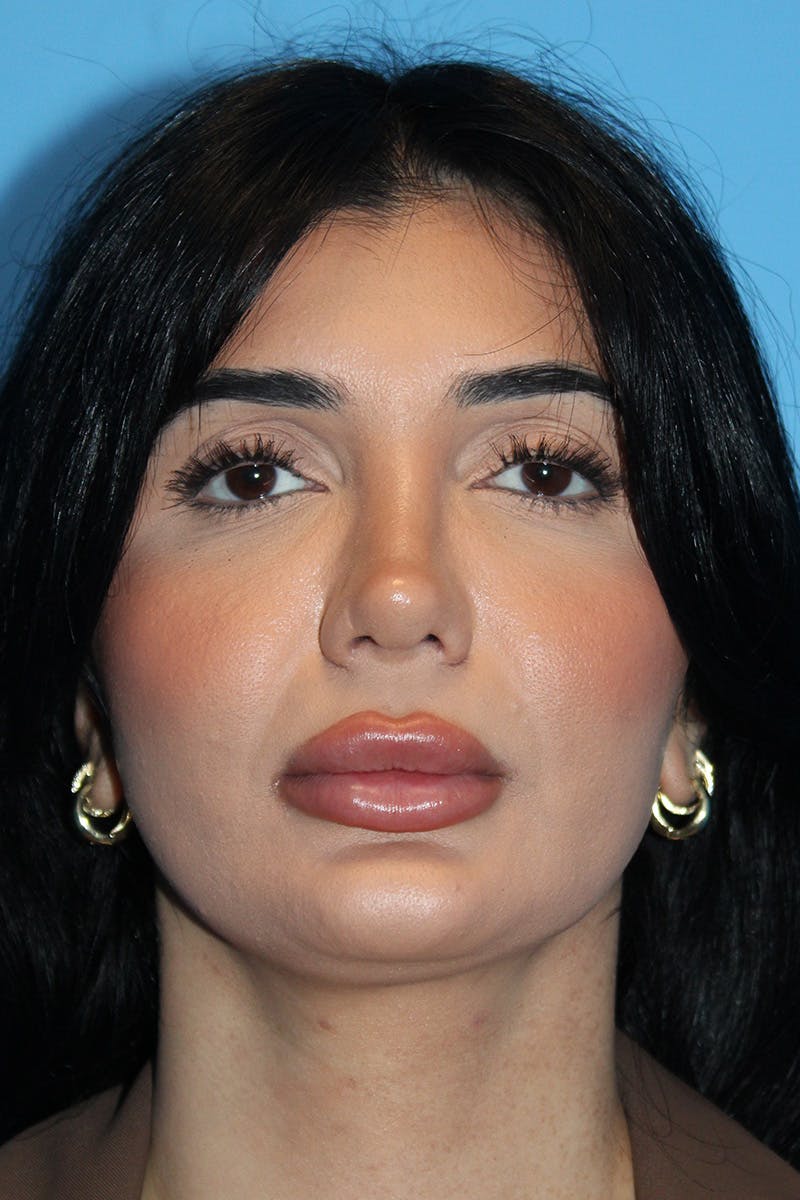 Revision Rhinoplasty Before & After Gallery - Patient 205479 - Image 4