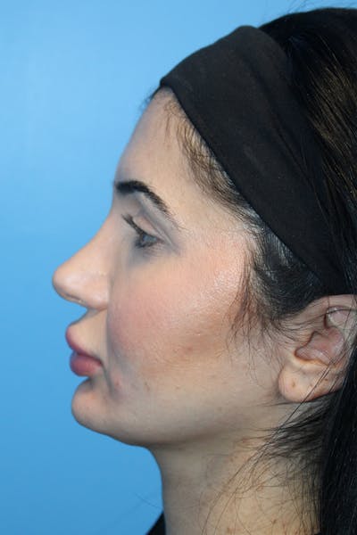 Revision Rhinoplasty Before & After Gallery - Patient 205479 - Image 1
