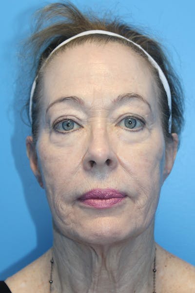 SWIFT LIFT ® / Facelift / Necklift  Before & After Gallery - Patient 386692 - Image 1