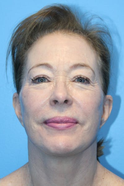 SWIFT LIFT ® / Facelift / Necklift  Before & After Gallery - Patient 386692 - Image 2