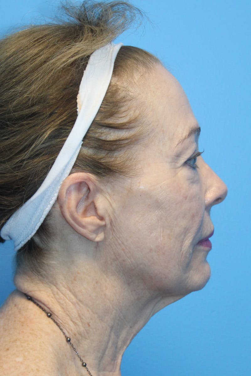 SWIFT LIFT ® / Facelift / Necklift  Before & After Gallery - Patient 386692 - Image 3