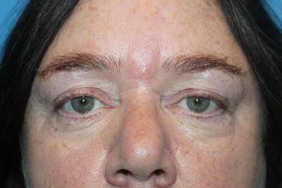 Eye Surgery Before & After Gallery - Patient 932080 - Image 1