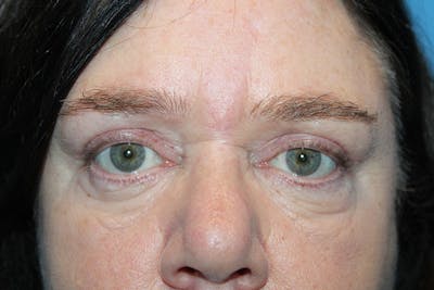 Eye Surgery Before & After Gallery - Patient 932080 - Image 2