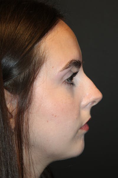 Rhinoplasty Before & After Gallery - Patient 249474 - Image 1