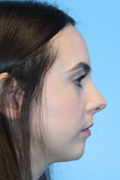 Rhinoplasty Before & After Gallery - Patient 249474 - Image 2