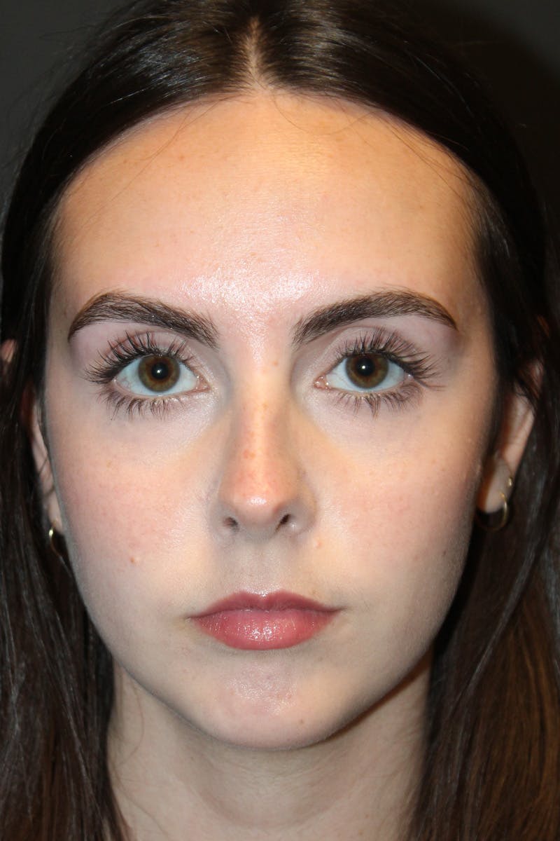 Rhinoplasty Before & After Gallery - Patient 249474 - Image 3