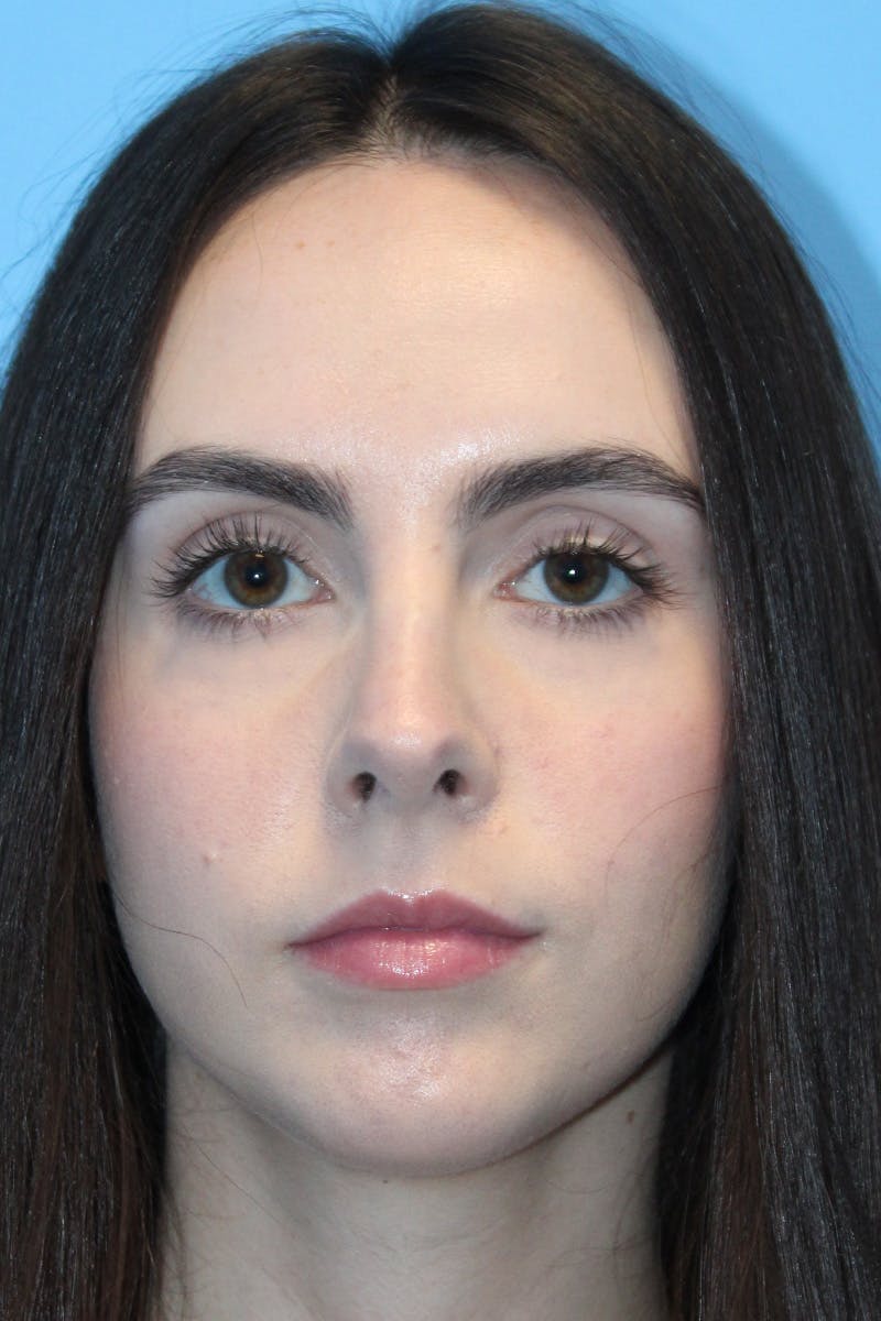 Rhinoplasty Before & After Gallery - Patient 249474 - Image 4