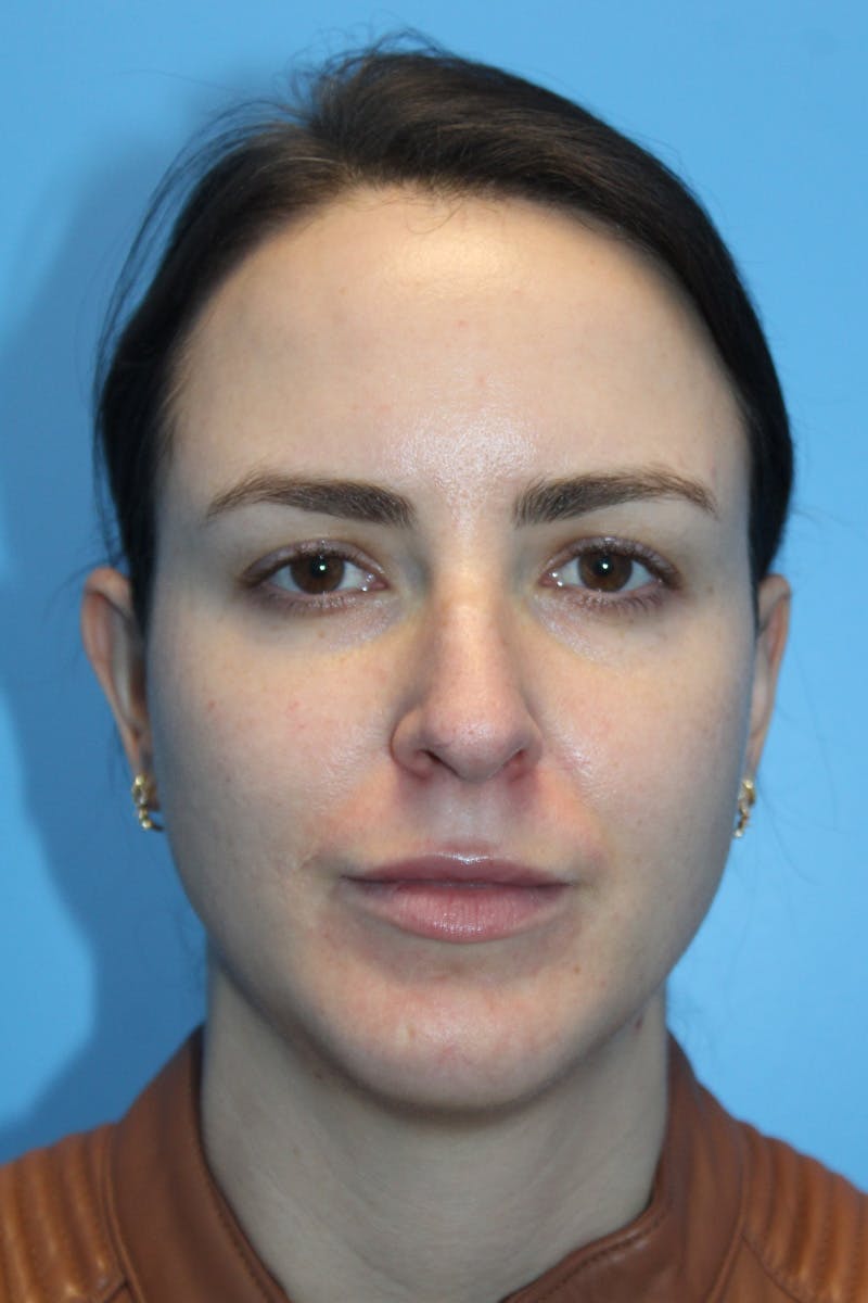 Rhinoplasty Before & After Gallery - Patient 826995 - Image 3
