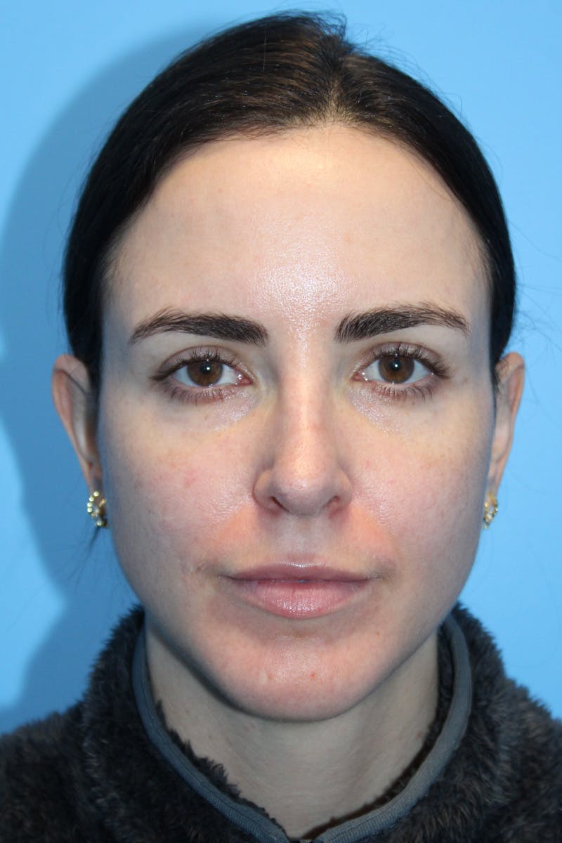 Rhinoplasty Before & After Gallery - Patient 826995 - Image 4