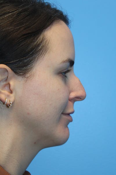 Rhinoplasty Before & After Gallery - Patient 826995 - Image 1