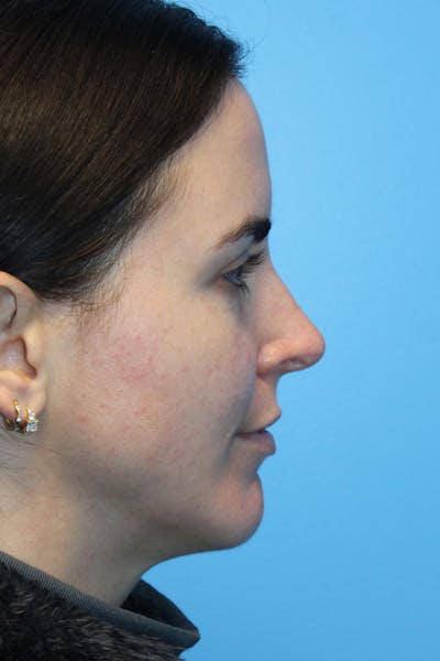 Rhinoplasty Before & After Gallery - Patient 826995 - Image 2