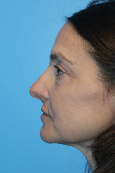Rhinoplasty Before & After Gallery - Patient 275936 - Image 1
