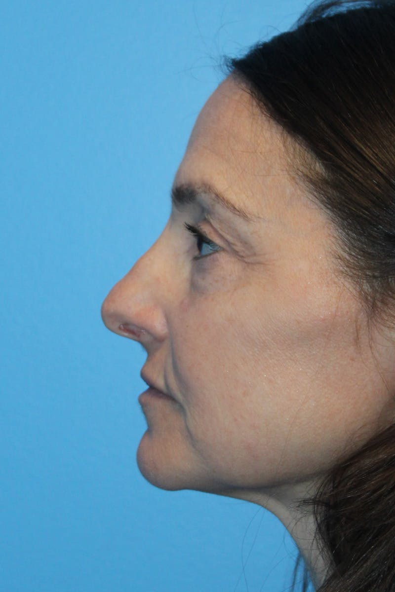 Rhinoplasty Before & After Gallery - Patient 275936 - Image 1