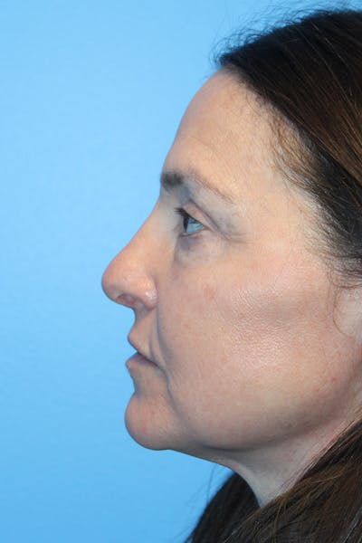 Rhinoplasty Before & After Gallery - Patient 275936 - Image 2