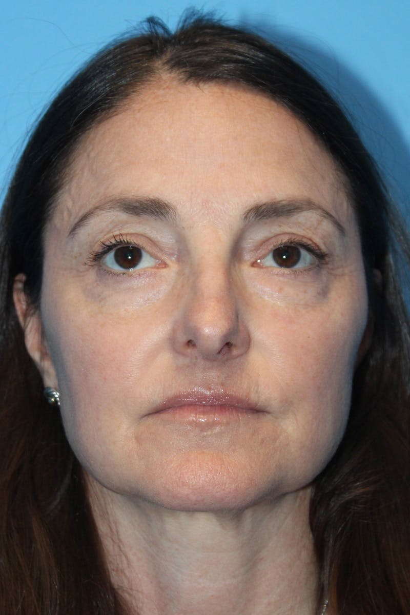 Rhinoplasty Before & After Gallery - Patient 275936 - Image 3