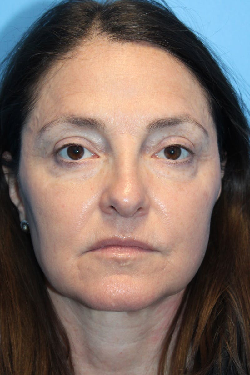 Rhinoplasty Before & After Gallery - Patient 275936 - Image 4