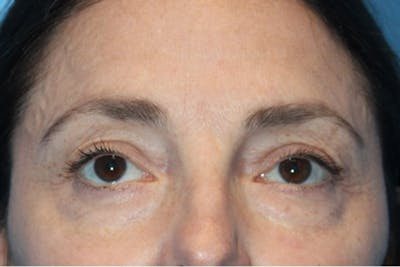Eye Surgery Before & After Gallery - Patient 135436 - Image 1
