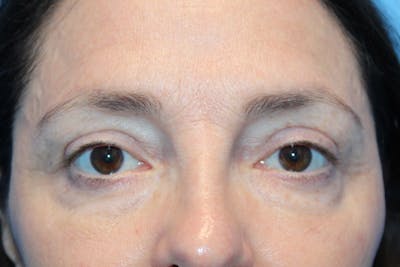Eye Surgery Before & After Gallery - Patient 135436 - Image 2