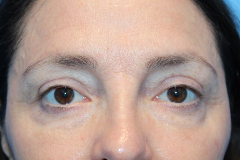 Eye Surgery Before & After Gallery - Patient 135436 - Image 2