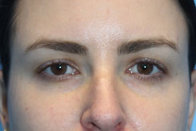 Eye Surgery Before & After Gallery - Patient 110439 - Image 1