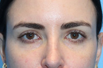 Eye Surgery Before & After Gallery - Patient 110439 - Image 2