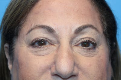Eye Surgery Before & After Gallery - Patient 275389 - Image 1