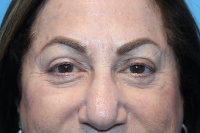 Eye Surgery Before & After Gallery - Patient 275389 - Image 2
