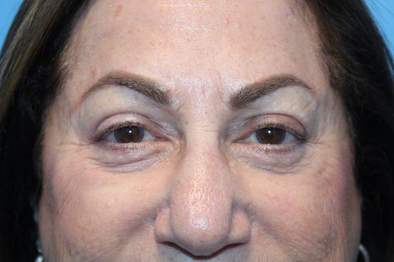 Eye Surgery Before & After Gallery - Patient 275389 - Image 2