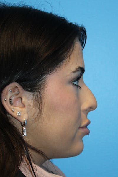Rhinoplasty Before & After Gallery - Patient 347851 - Image 1